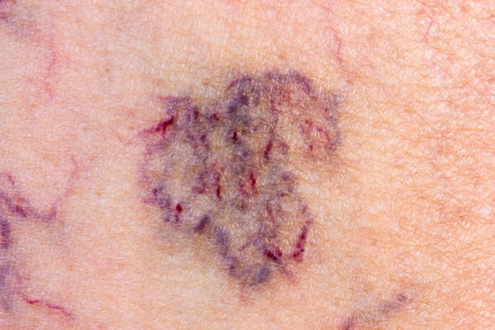 Varicose Veins: Causes, Prevention, and Treatment
