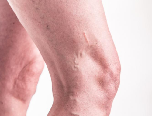 What to Expect After Vein Treatment