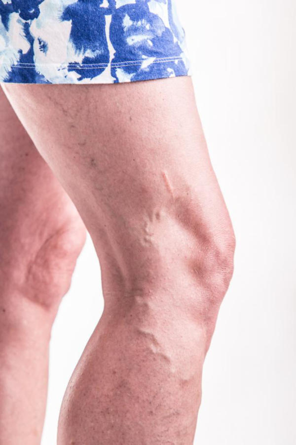 What To Expect After Veins Treatment Varicose Veins Doctors